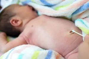 أسباب نزيف السرة عند الطفل حديث الولادة