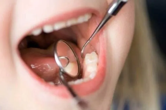 تعلم كيفية الحفاظ أسنانك من التسوس والبكتيريا