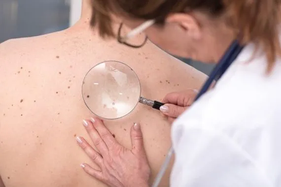 الكشف عن كيفية تحول بقعة صغيرة غير مرئية إلى سرطان الجلد القاتل