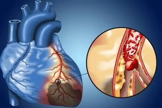 فريق بحثي يكتشف آلية غير متوقعة وراء تلف القلب بعد النوبات