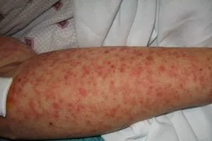 كردستان يسجل إصابة جديدة بالحمى النزفية