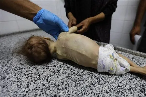 جوع وتشوهات الأونروا تكشف كابوساً صحياً يضرب غزة بصمت قناة العالم الاخبارية