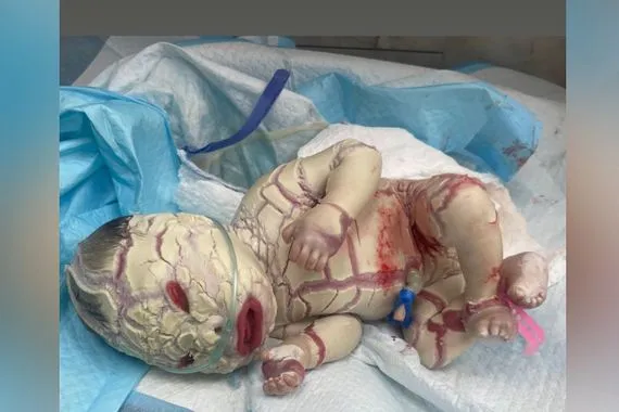 ولادة طفل بجلد يشبه قشر السمكة في ديالى