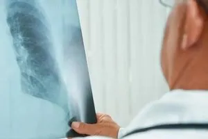 اكتشاف فيروس يقضي على مسببات الالتهاب الرئوي