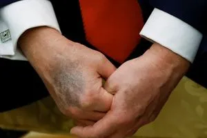 مخاوف صحية حول ترامب بعد ظهور كدمة داكنة جديدة على يده