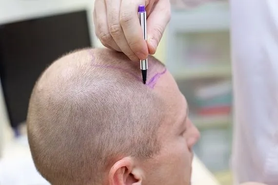 بلغ 11 مليار دولار سوق زراعة الشعر ينمو بوتيرة غير مسبوقة عالمياً
