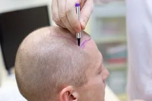 بلغ 11 مليار دولار سوق زراعة الشعر ينمو بوتيرة غير مسبوقة عالمياً