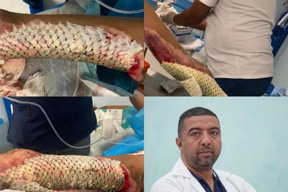 جلد السمك معجزة تلتئم بها الحروق في مستشفى الحكيم وكالة بغداد اليوم الاخبارية