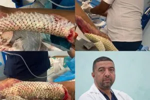 جلد السمك معجزة تلتئم بها الحروق في مستشفى الحكيم وكالة بغداد اليوم الاخبارية