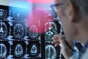 طريقة ثورية لرصد علامات ألزهايمر قبل بدايته وكالة الانباء العراقية واع