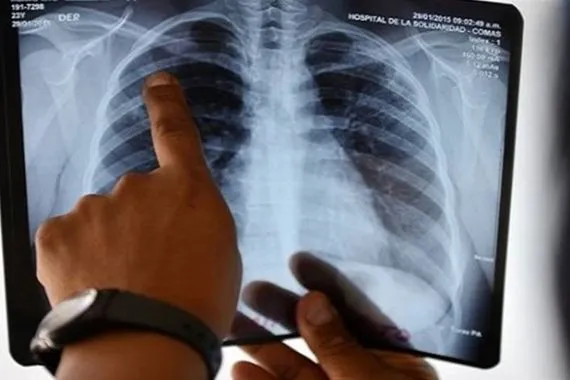 الذكاء الاصطناعي سرّع الكشف الصحة العراق تفوّق على النسبة العالمية لعلاج التدرن وبلغت 94