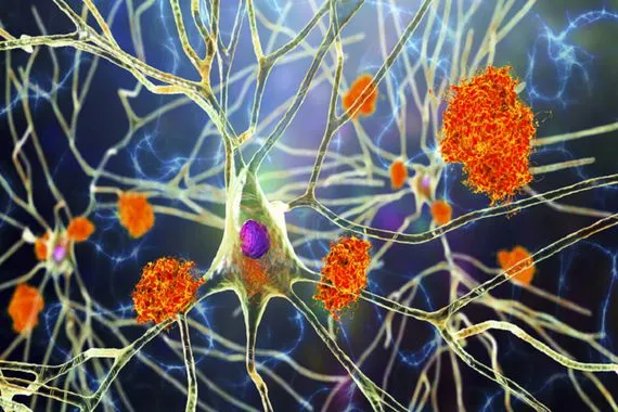 النبات المعجزة مفتاح جديد لعلاج ألزهايمر