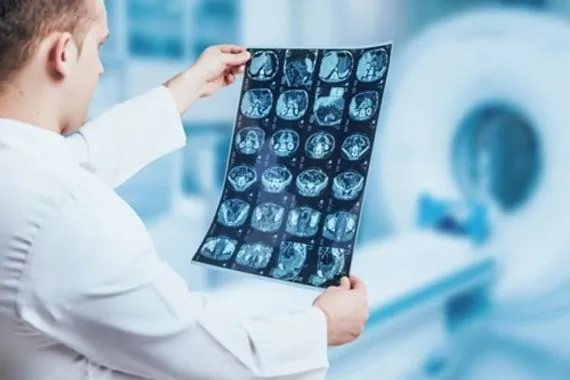 باحثون يطورون علاجاً مبتكراً لسرطان الدماغ عبر قطرات أنفية