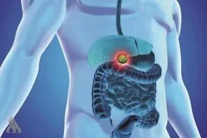 اختراق علمي في مواجهة السرطان الصامت للقنوات الصفراوية وكالة الانباء العراقية واع