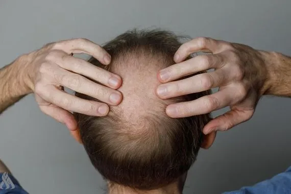 دواء جديد لمعالجة الصلع الوراثي لدى الرجال وكالة الانباء العراقية واع