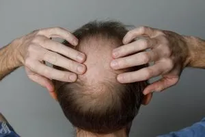 دواء جديد لمعالجة الصلع الوراثي لدى الرجال وكالة الانباء العراقية واع