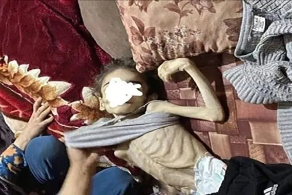 أونروا 508 أطفال في غزة مصابون بسوء تغذية حاد