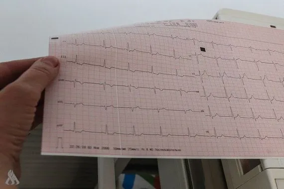 تطوير نماذج قلبية ثلاثية الأبعاد تفتح آفاقًا جديدة لفهم الرجفان الأذيني وكالة الانباء العراقية واع