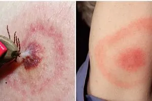 بعد عقود من التكتم تحقيق رسمي يكشف غموض انتشار مرض لايم في أميركا شفق نيوز