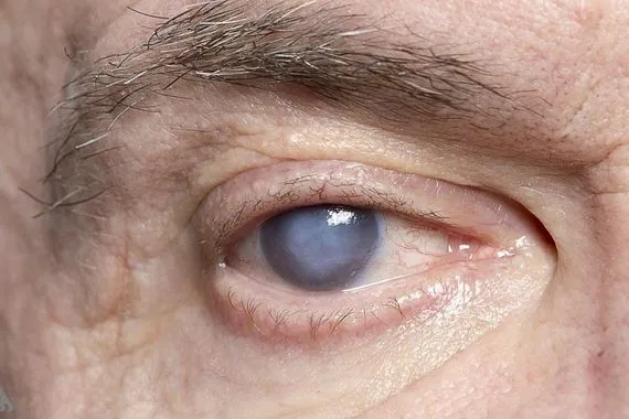 تأثير خفي لمرض السكري على صحة العين وكالة الانباء العراقية واع