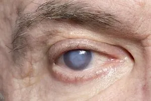 تأثير خفي لمرض السكري على صحة العين وكالة الانباء العراقية واع