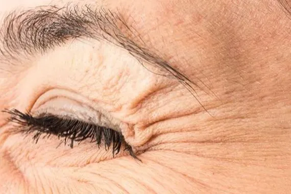 تجاعيد أقدام الغراب قد تنذر بخطر الخرف والزهايمر شفق نيوز