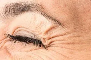 تجاعيد أقدام الغراب قد تنذر بخطر الخرف والزهايمر شفق نيوز