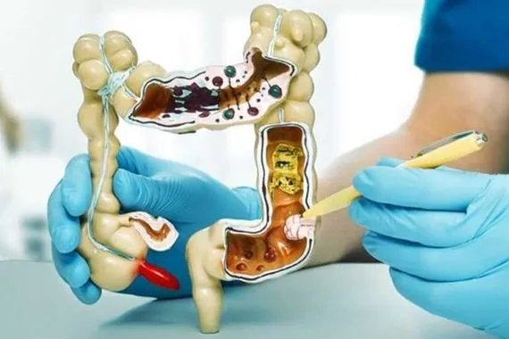 خبراء يكتشفون برنامجاً خفياً يمهد لسرطان القولون